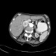 Renal carcinoma, Grawitz tumour, trombus in inferior vena cava, tumor thrombus: CT - Computed tomography